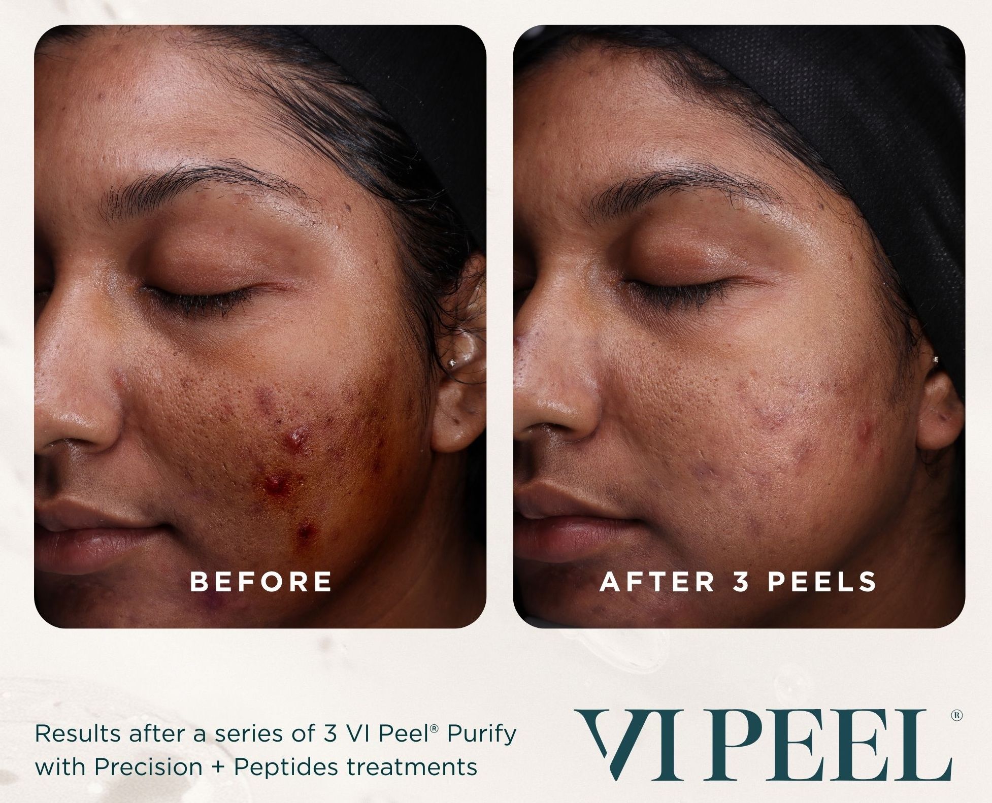 VI Peel 